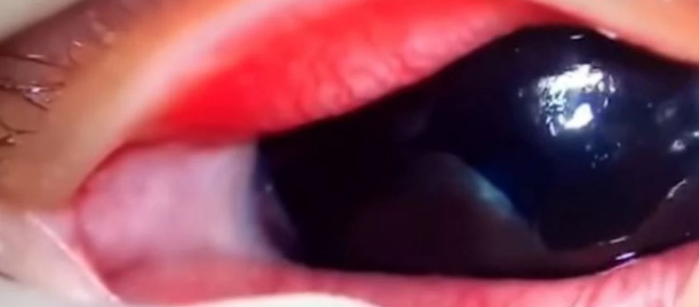 Γιατροί έβγαλαν σκουλήκια από το μάτι βρέφους – Μολύνθηκε από κατοικίδιο (φώτο-βίντεο)